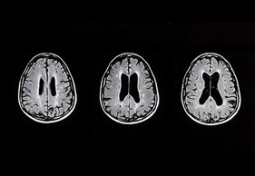 Chorea Huntington Neurologienetz